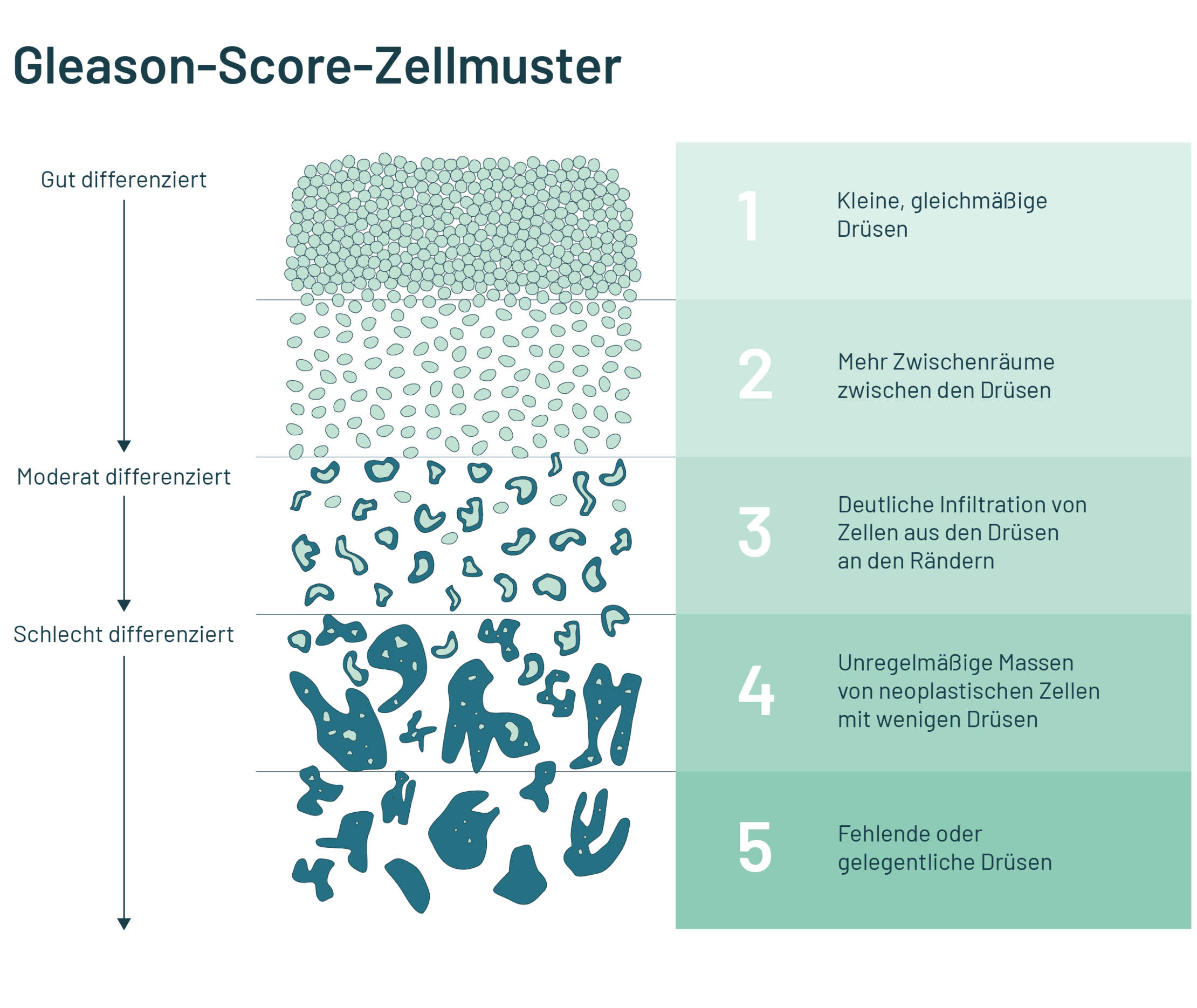 Schematische Darstellung der Zellmuster im Gleason-Score. 