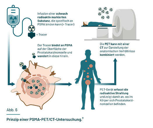 Gezeigt ist die Funktionsweise einer PSMA-PET/CT-Untersuchung: Per Infusion wird eine radioaktiv markierte Substanz (Tracer) verabreicht, die an PSMA binden kann. Der Tracer wandert in die Prostatakrebszelle hinein. Die Bildgebung erfasst den strahlenden Tracer.