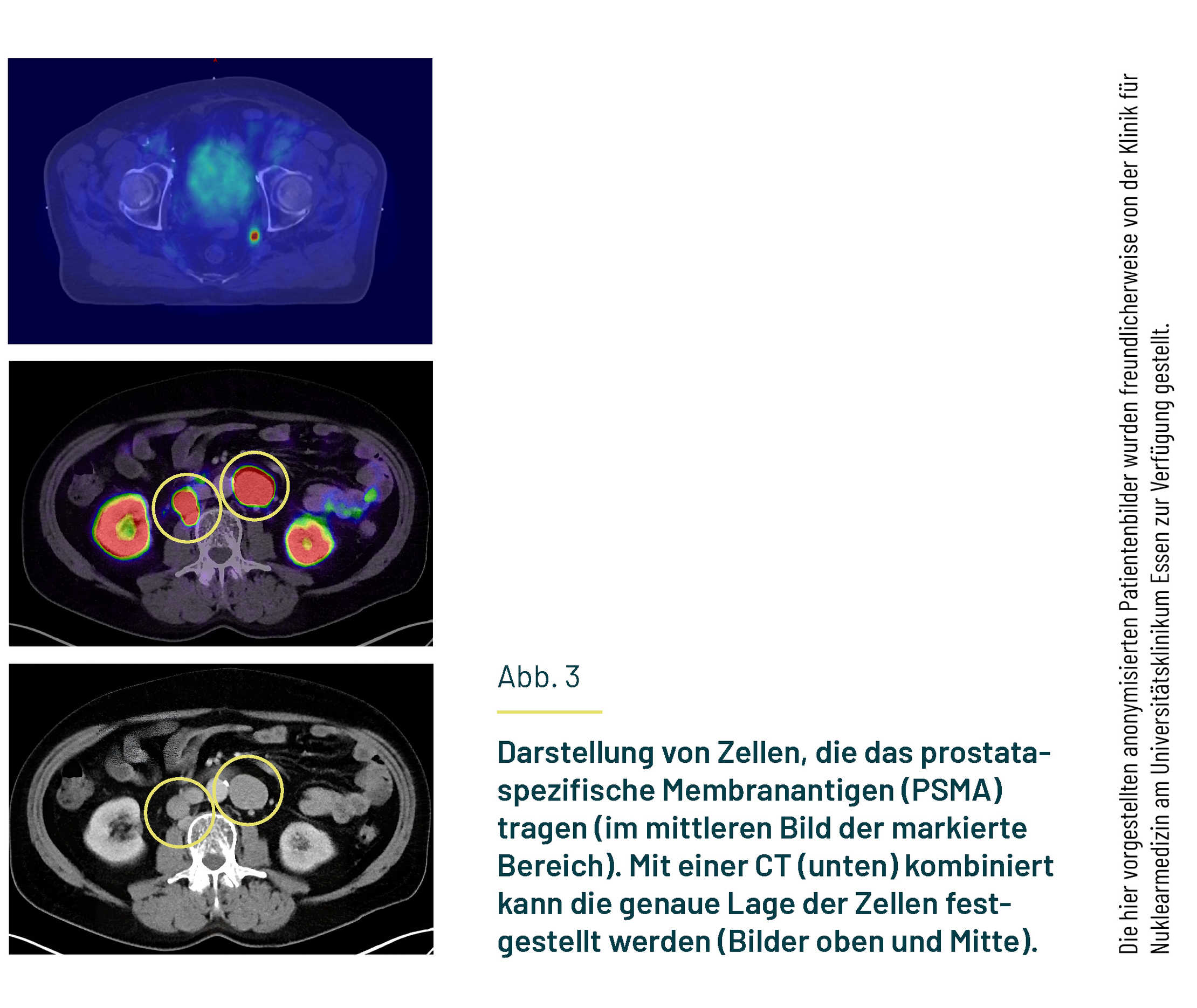 Gezeigt sind ein SPECT-Gerät und eine Darstellung eines SPET/CT-Scans.