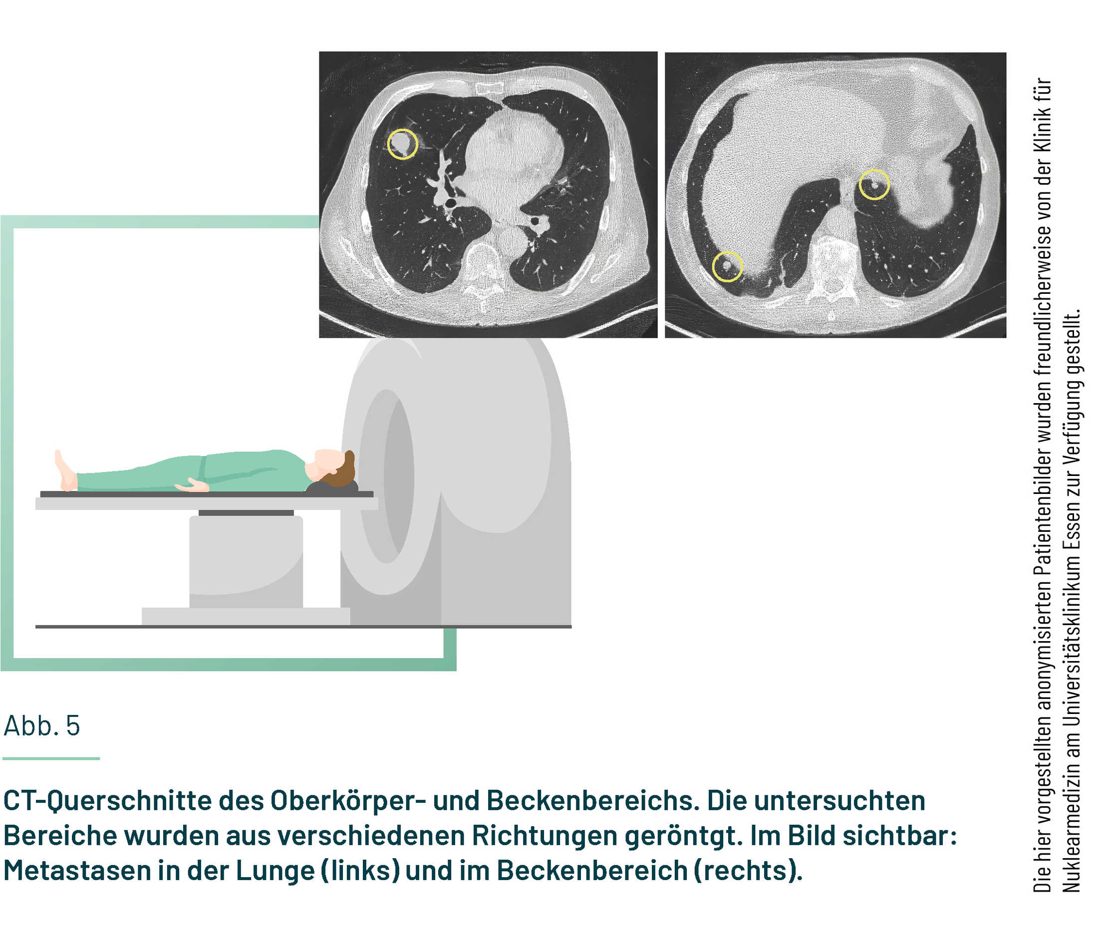 Gezeigt sind ein CT-Scanner und die klinische CT-Aufnahme einer Prostata.