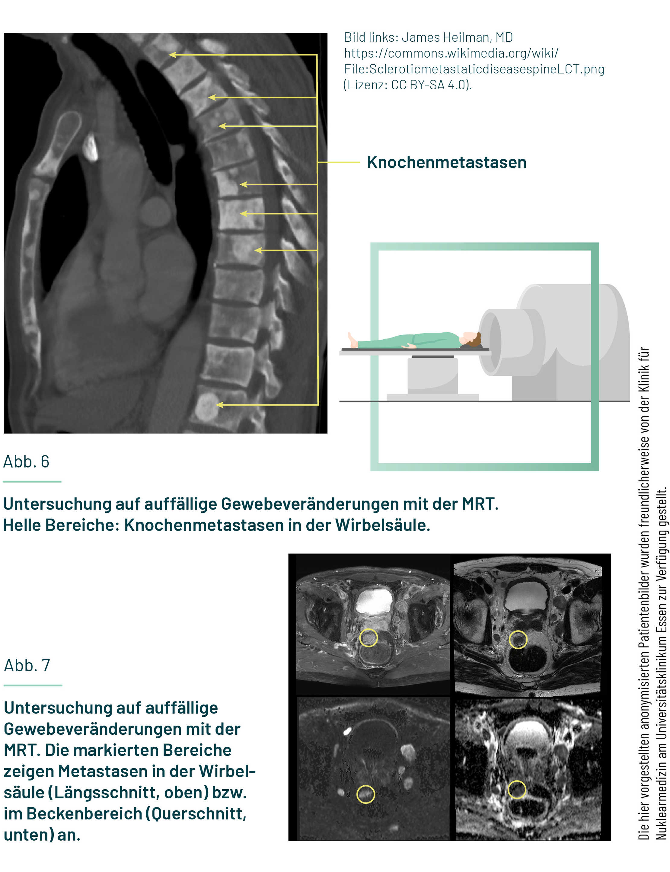 xGezeigt sind ein MRT-Scanner und die MRT-Aufnahme einer Wirbelsäule mit Metastasen.
