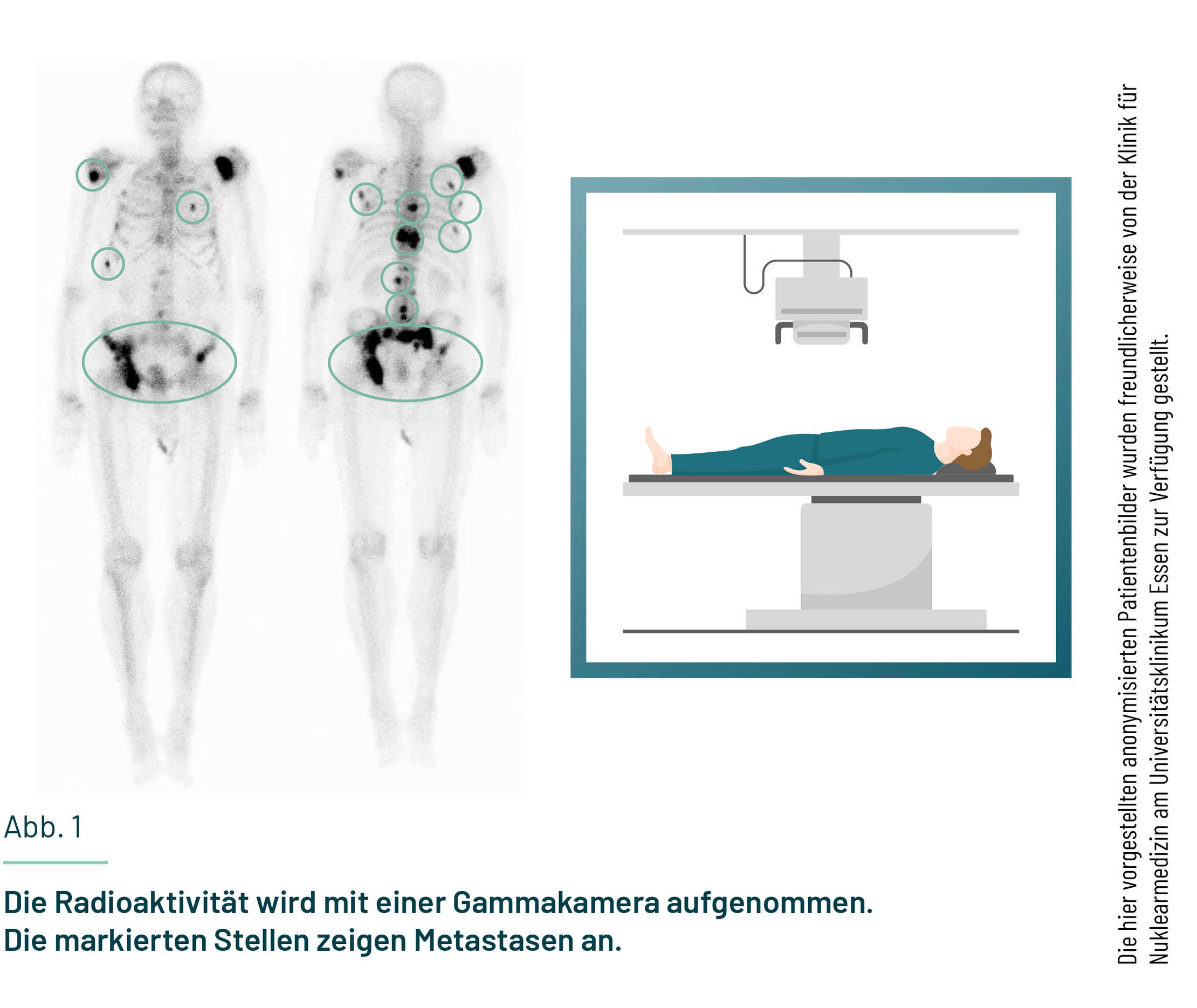 Leben mit Prostatakrebs: Gezeigt sind ein Skelettszintigraphie-Scanner und eine Ganzkörper-Aufnahme mit dunklen Flecken im Skelett. Gezeigt sind ein Skelettszintigraphie-Scanner und eine Ganzkörper-Aufnahme mit dunklen Flecken im Skelett.