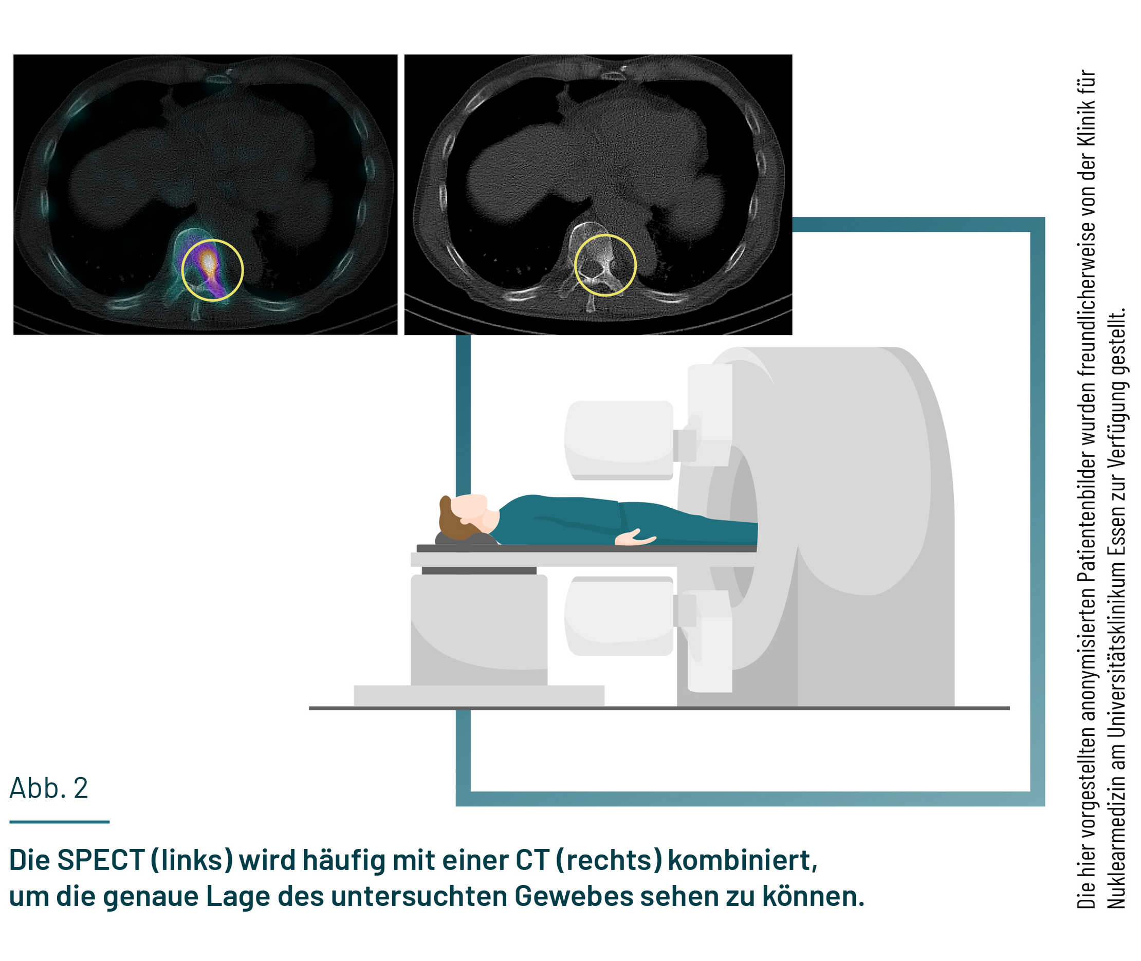 Gezeigt sind ein SPECT-Gerät und eine Darstellung eines SPET/CT-Scans.
