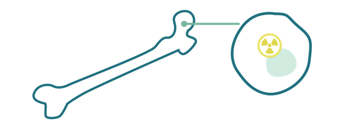 Zu sehen sind ein Oberschenkelknochen und in Vergrößerung eine Metastase mit einem radioaktiven Symbol.