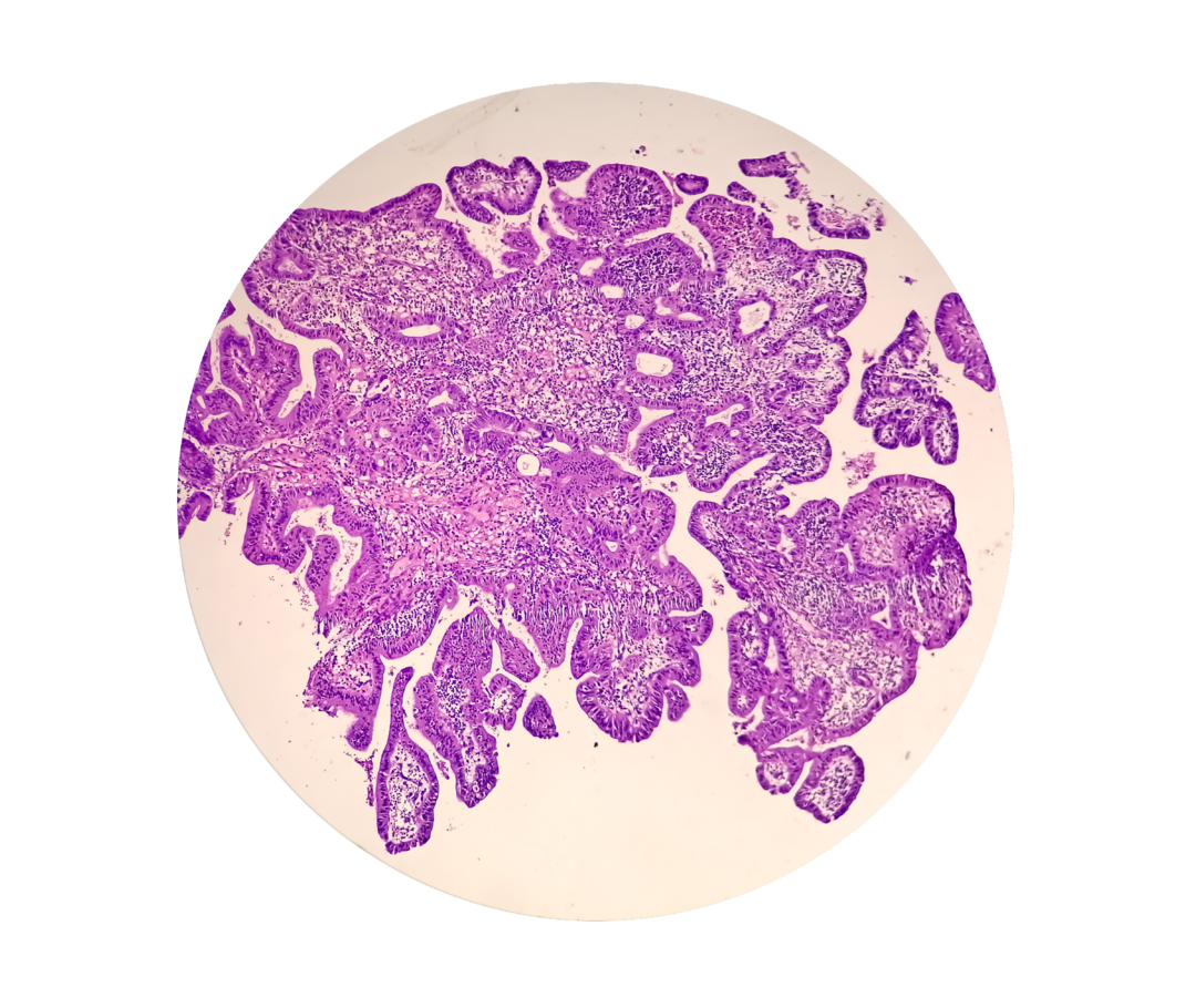 Es ist ein histologischer Schnitt von Prostatakrebsgewebe zu sehen.
