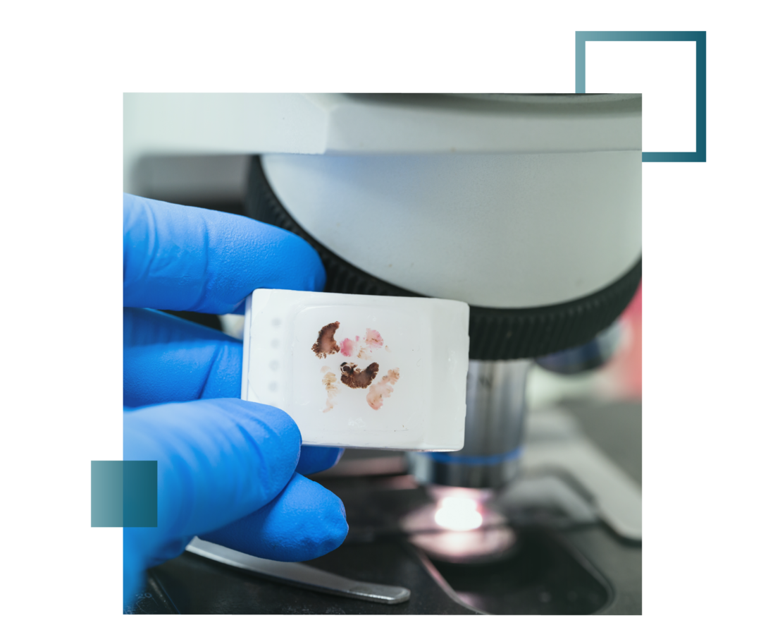 Abgebildet ist ein Paraffinblock, in dem Gewebe in der Pathologie für Feinschnitte aufbereitet wird. 