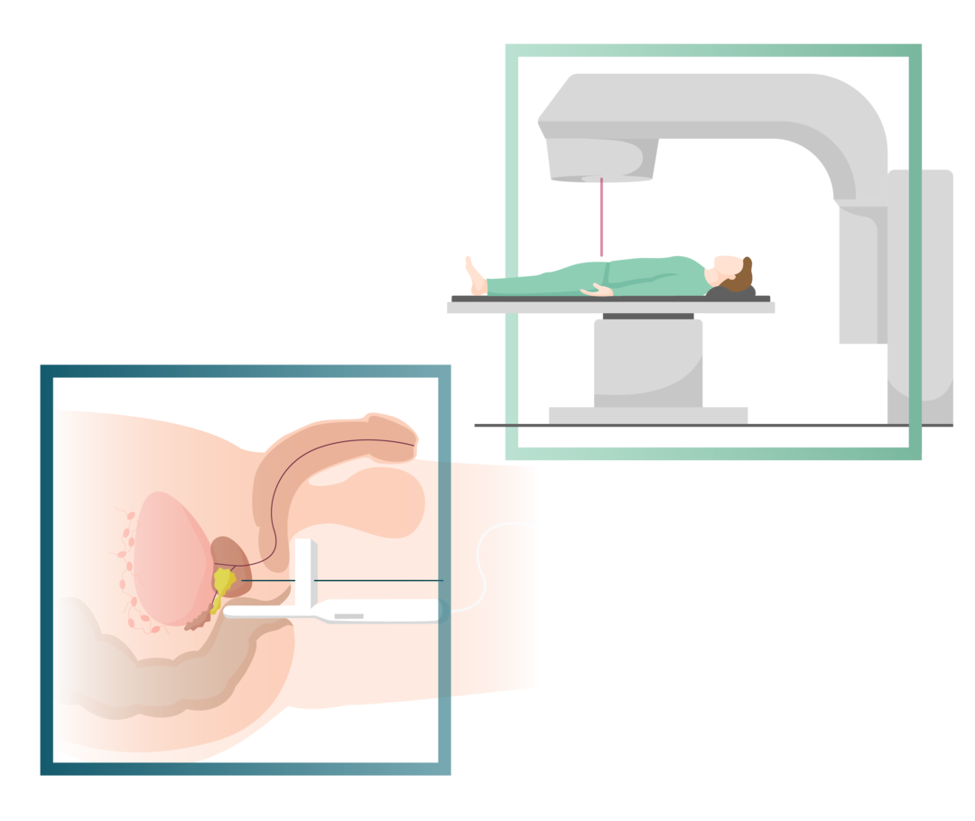 Leben mit Prostatakarzinom: Die Abbildung zeigt schematisch die Funktionsweise eines Linearbeschleunigers.  Die Abbildung zeigt schematisch die Funktionsweise eines Linearbeschleunigers.