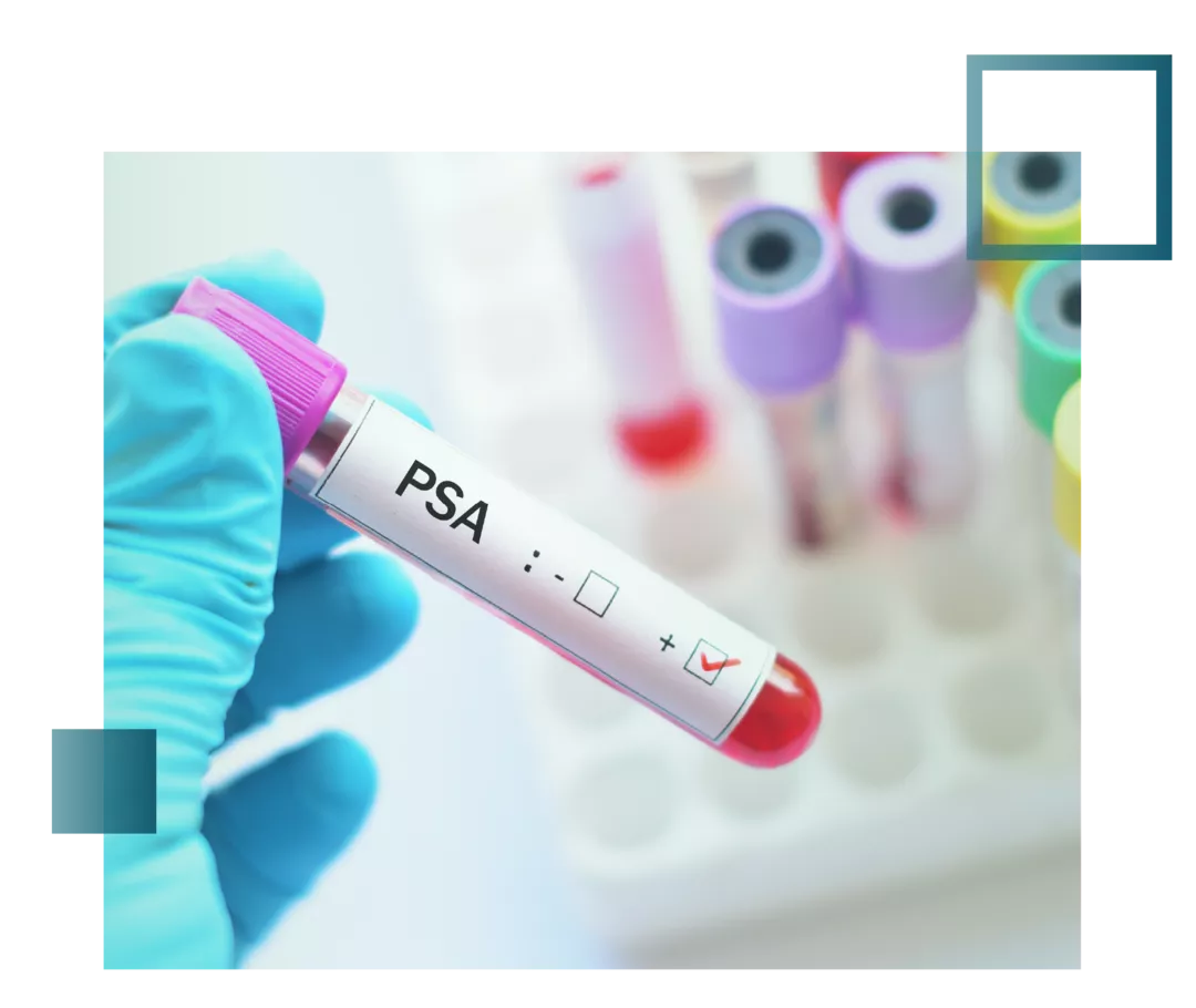 Abgebildet ist eine Hand, die eine Blutprobe im Röhrchen mit der Aufschrift PSA hält.