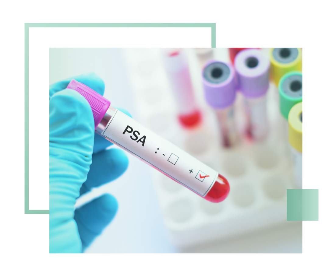 Leben mit fortgeschrittenem Prostatakarzinom: Abgebildet ist ein Reagenzglas mit dem Aufkleber PSA. Abgebildet ist ein Reagenzglas mit dem Aufkleber PSA.