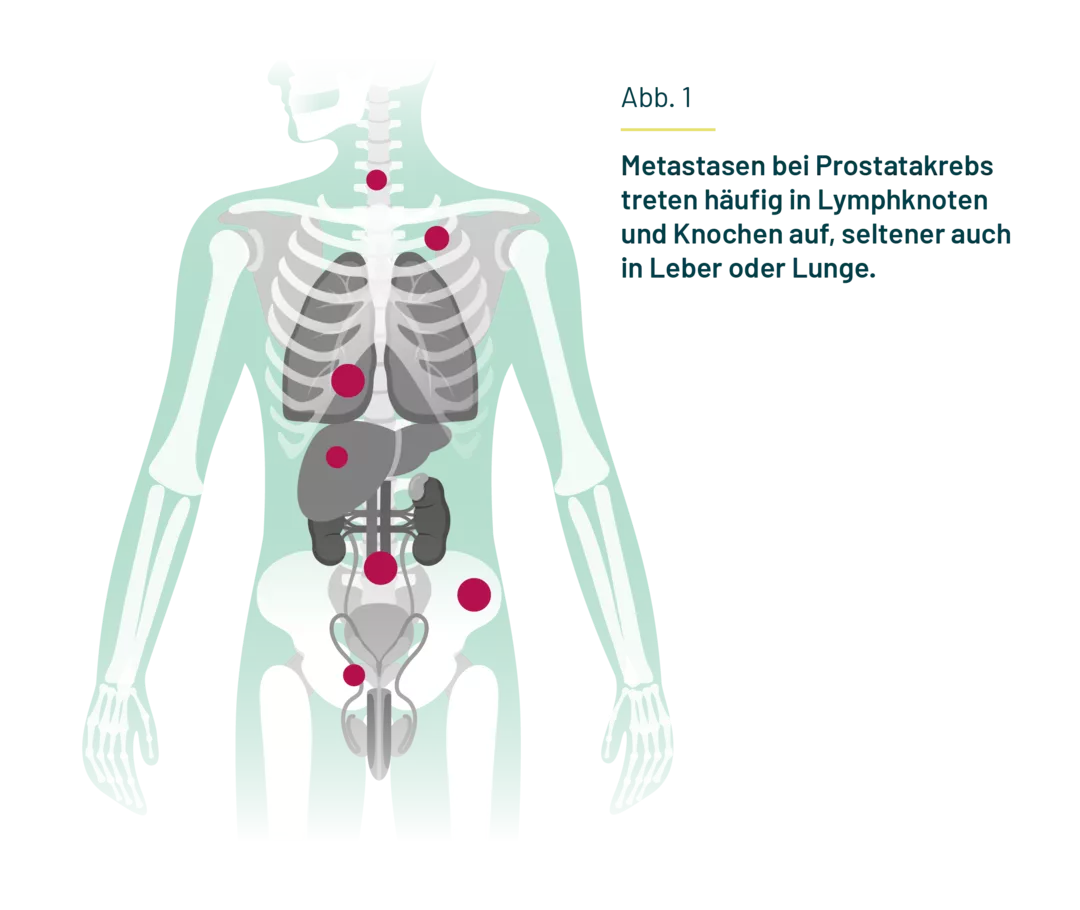 Dargestellt ist ein Körper mit Skelett und inneren Organen. An Lymphknoten, Knochen, Leber und Lunge sind Markierungen als Symbol dafür angebracht, wo Metastasen bei Prostatakarzinom auftreten können. Dargestellt ist ein Körper mit Skelett und inneren Organen. An Lymphknoten, Knochen, Leber und Lunge sind Markierungen als Symbol dafür angebracht, wo Metastasen bei Prostatakarzinom auftreten können.