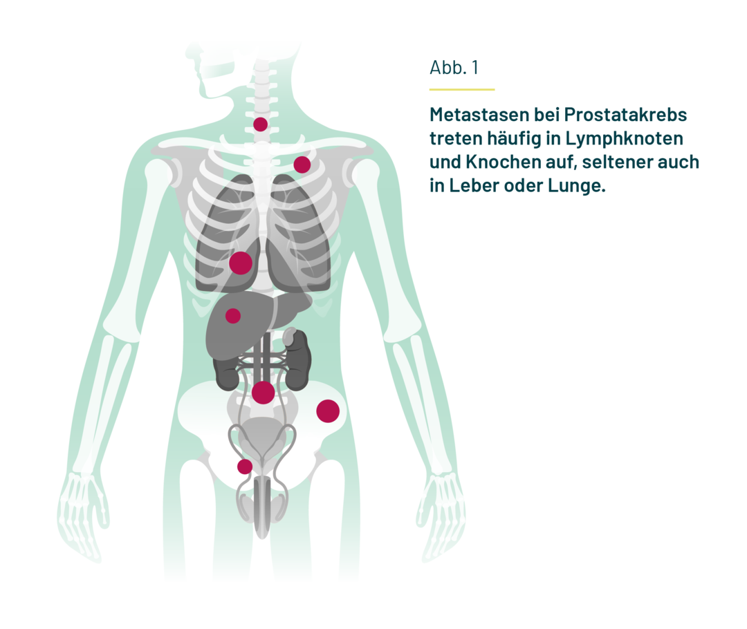 Dargestellt ist ein Körper mit Skelett und inneren Organen. An Lymphknoten, Knochen, Leber und Lunge sind Markierungen als Symbol dafür angebracht, wo Metastasen bei Prostatakarzinom auftreten können.