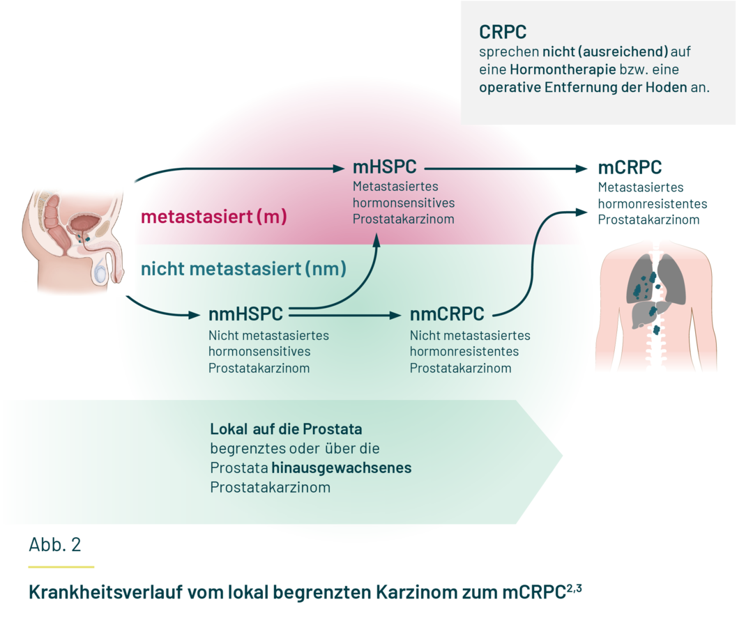 Die Entwicklungen von nicht metastasiertem zu metastasiertem und hormonsensitivem zu hormonresistentem Tumor sind in zwei Strängen abgebildet. Am Ende führen beide Stränge zum mCRPC. Die Entwicklungen von nicht metastasiertem zu metastasiertem und hormonsensitivem zu hormonresistentem Tumor sind in zwei Strängen abgebildet. Am Ende führen beide Stränge zum mCRPC.