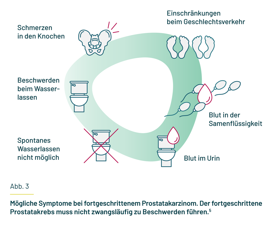 Auflistung der möglichen Symptome beim fortgeschrittenen Prostatakarzinom.