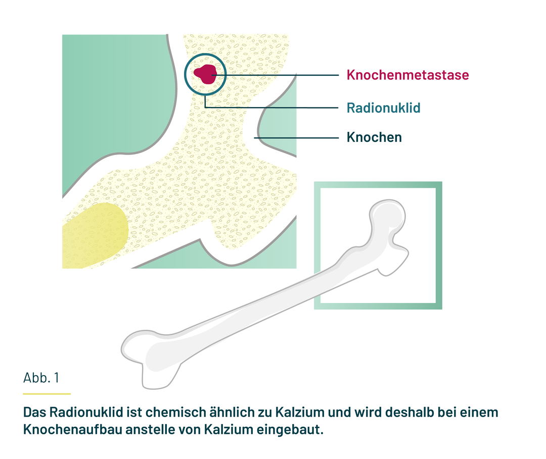 Das Radionuklid reichert sich an einer Knochenmetastase an und setzt dort radioaktive Strahlung frei. Das Radionuklid reichert sich an einer Knochenmetastase an und setzt dort radioaktive Strahlung frei.