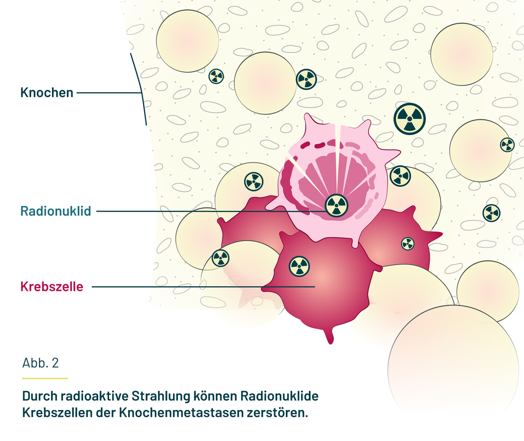 Das Radionuklid kann durch radioaktive Strahlung Krebszellen in den Metastasen zerstören.